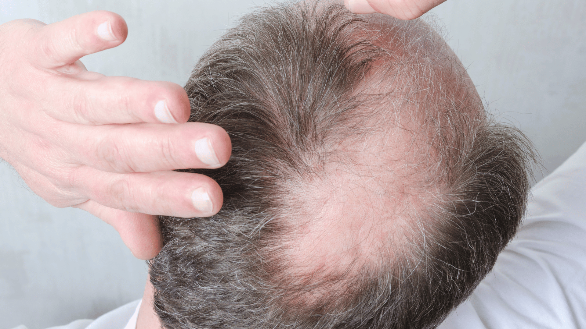 Minoxidil and Shedding Why it Happens and What to Expect