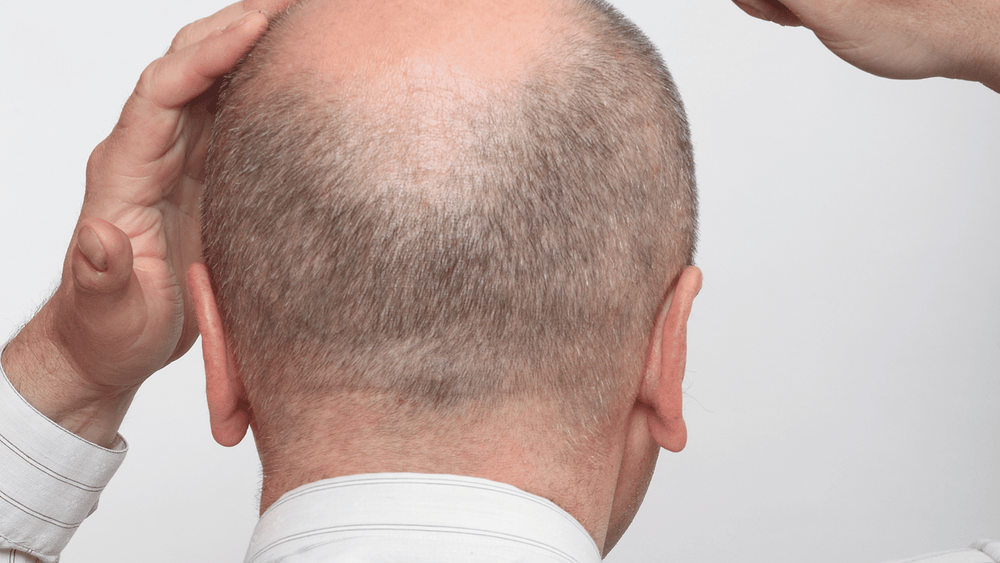 Female Hair Loss Treated with Oral Finasteride  Hair Transplant Case  Study News  McGrath Medical
