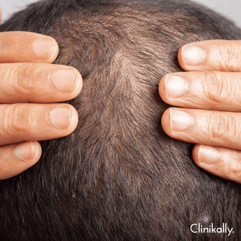 Recognizing early signs of Alopecia Areata