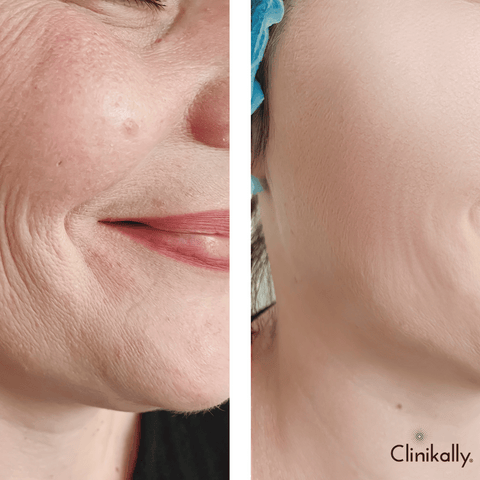 Effectively treat wrinkles and fine lines!