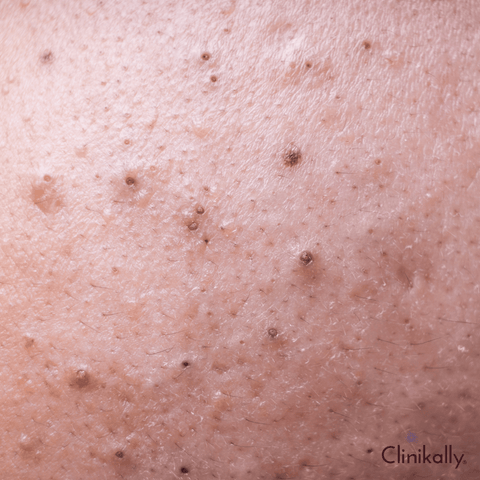 Are pimples bad for health?