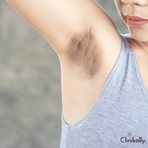 Do dark underarms go away?