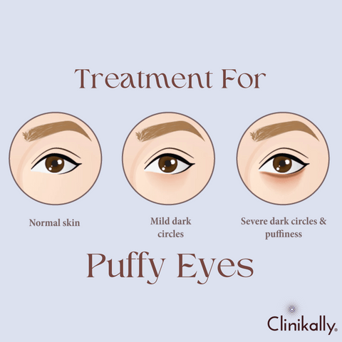 #7 Treatment for puffy eyes