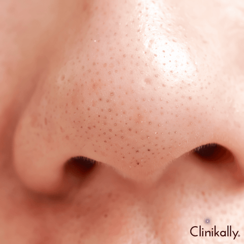 Benzoyl peroxide for blackheads & whiteheads