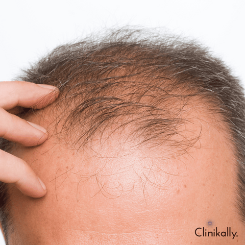 Stages of Male Pattern Baldness