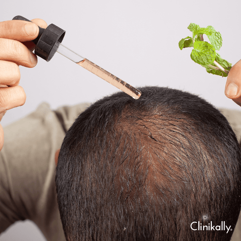 Tackle Male Pattern Baldness with Science!