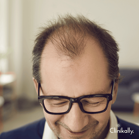 Symptoms of Male Pattern Baldness