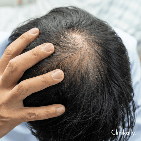 Identifying The Stage of Male Pattern Baldness