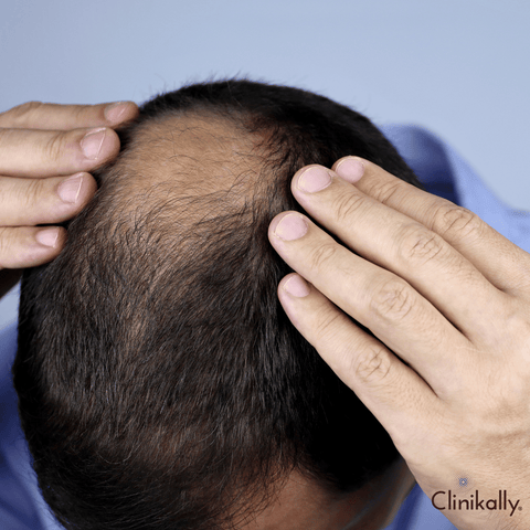 Symptoms of Alopecia Areata