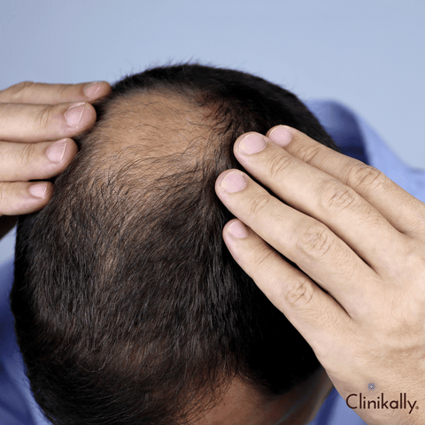 Comparative analysis of Redensyl and Minoxidil