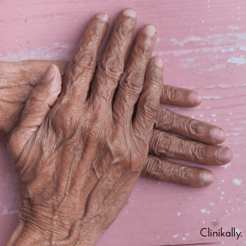 Home remedies to reduce wrinkles on the hands