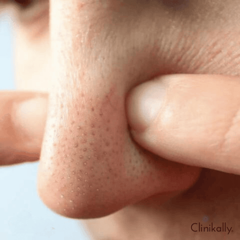 Blackheads