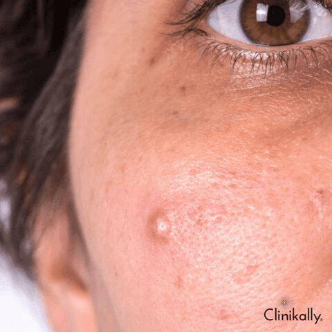 Papules