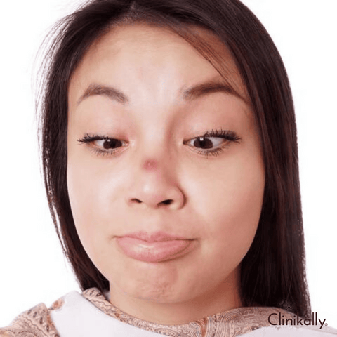 Causes of acne in women