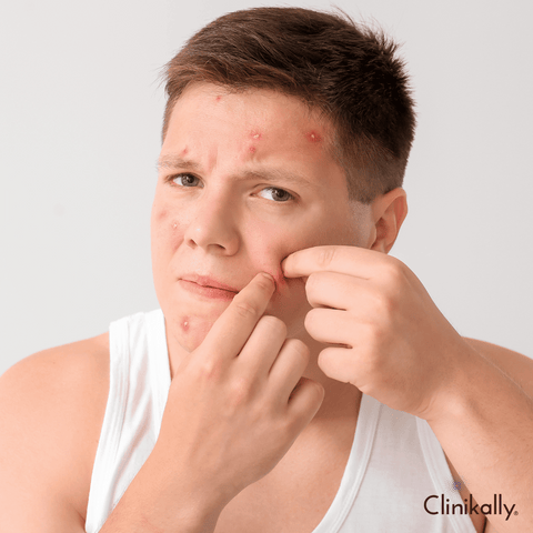 Managing acne for clearer skin