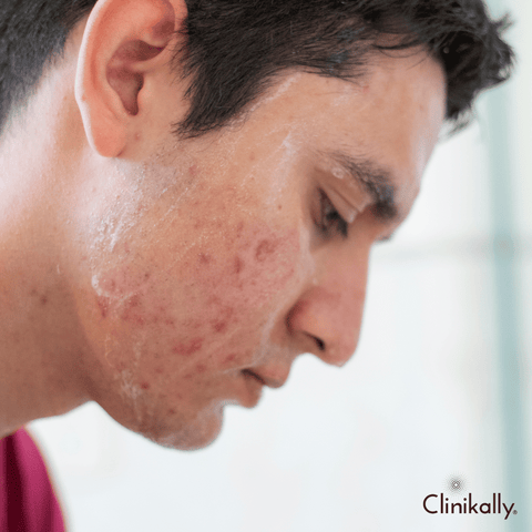 Causes of acne in men