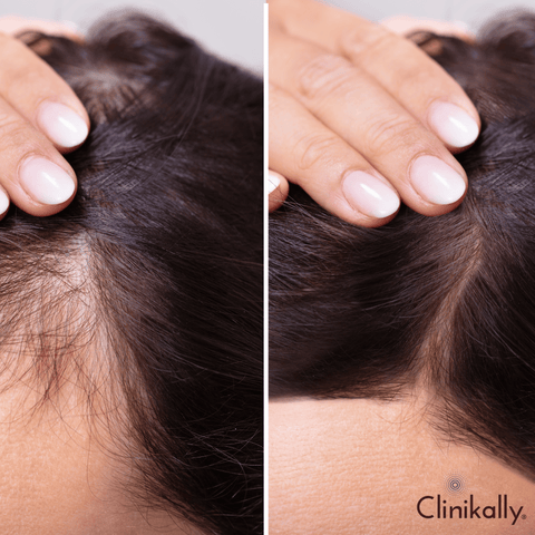 Methods for hair fall control