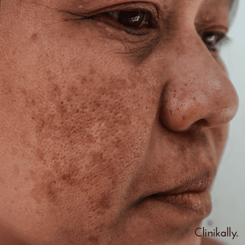 What are dark spots?