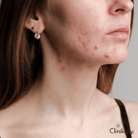 Understanding Acne Triggers and Prevention