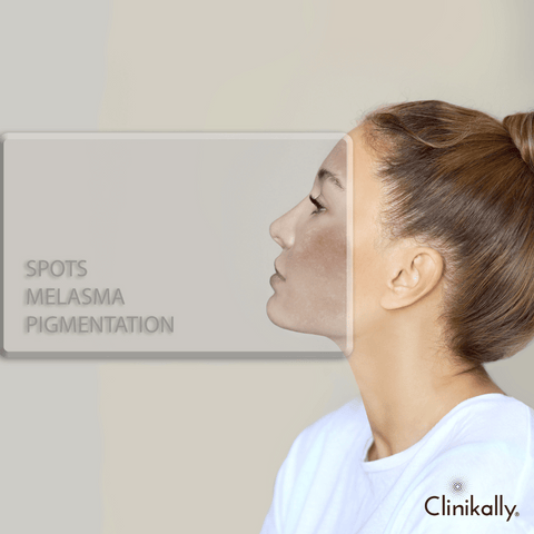 Differences between dark spots, sunspots, and melasma