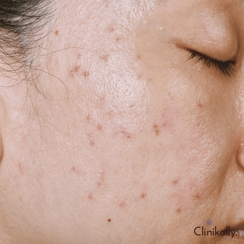 Post-Acne Care and Scar Treatment