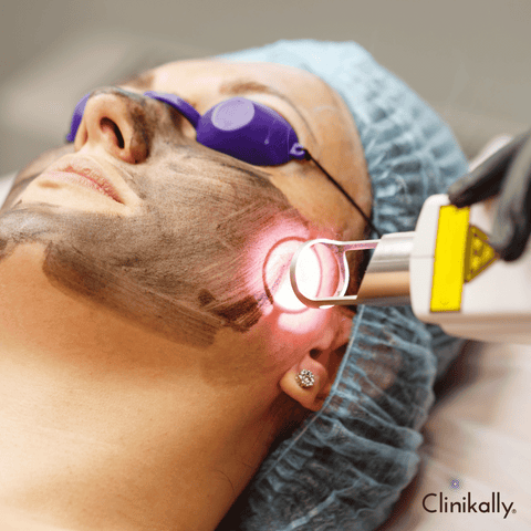 Laser treatments and microdermabrasion for dark spots
