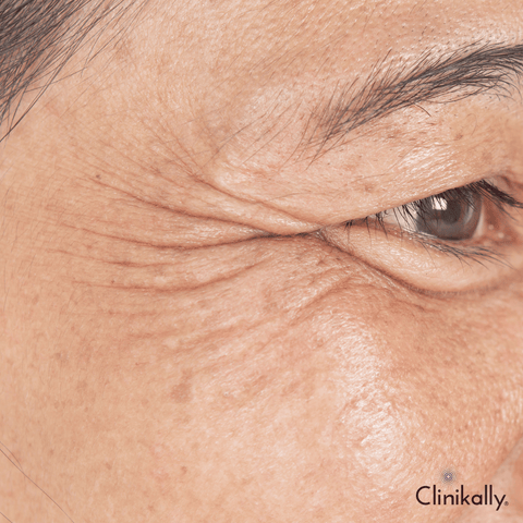 The science of Vitamin C and wrinkle reduction