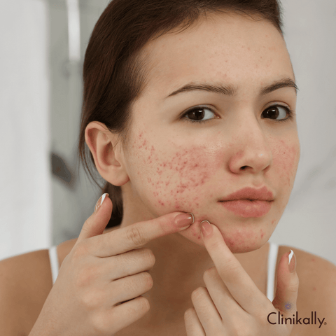 Acne and Blackheads: Common Issues with Strawberry Skin