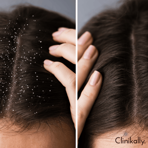 How Coconut Oil Fights Dandruff and Scalp Issues