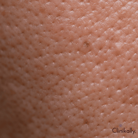 Is it possible to close open pores permanently?