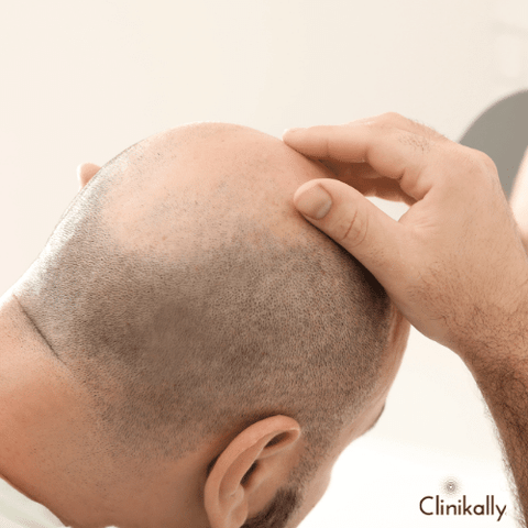 early male pattern baldness