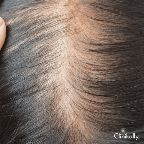 Causes of hair thinning