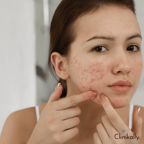 What Skin Issues Does Azelaic Acid Treat?