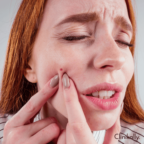 Acne Treatment: How Azelaic Acid Can Help Clear Your Skin