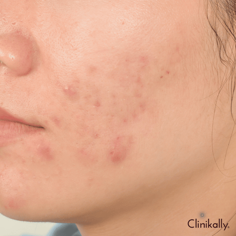 Ferulic acid for acne scars and blemishes