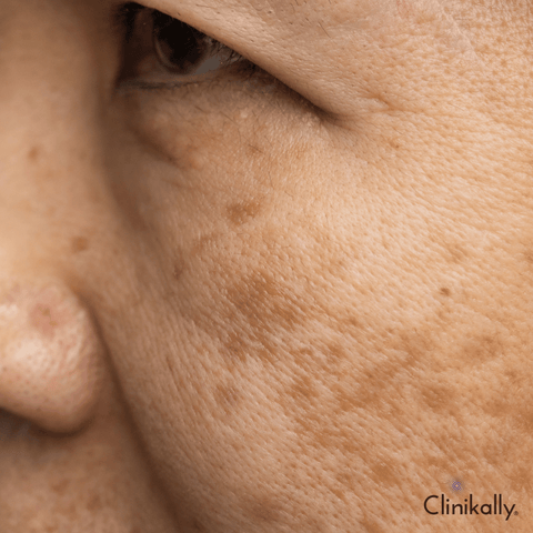 How does Glutathione reduce melanin and acne scars