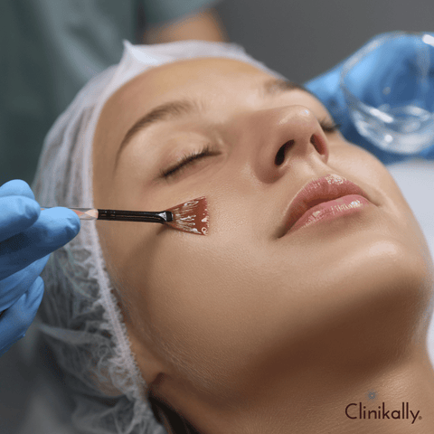 Exfoliation and Chemical Peels: Using Azelaic Acid for a Smoother Complexion