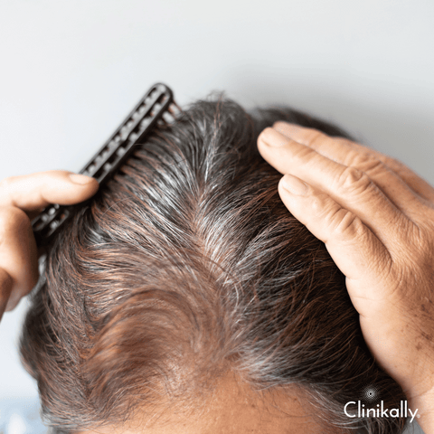 The Connection Between Magnesium Deficiency and Hair Loss