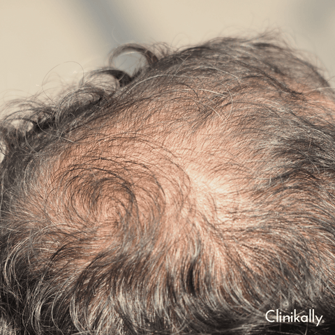 How Magnesium Can Help Alopecia