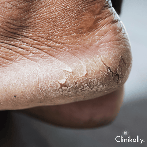 Caresse - Most of us tend to neglect our feet and do not care for them  enough. Consequently, they tend to get dry and results in cracked heels. Crack  Heel cream with