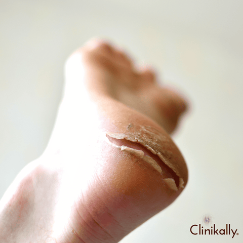 Cracked Heels: Treatment And Ayurvedic Home Remedies