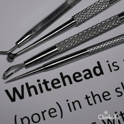 What causes Whiteheads