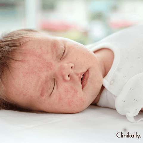 Eczema in infants and children