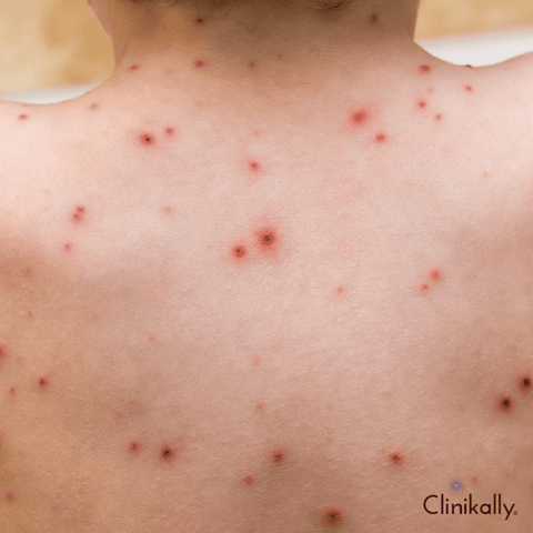 Is there a cure for chicken pox scars?