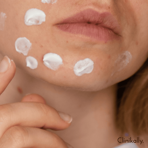 Best chicken pox scar removal creams