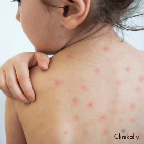 Reduce chicken pox scars with the right steps!