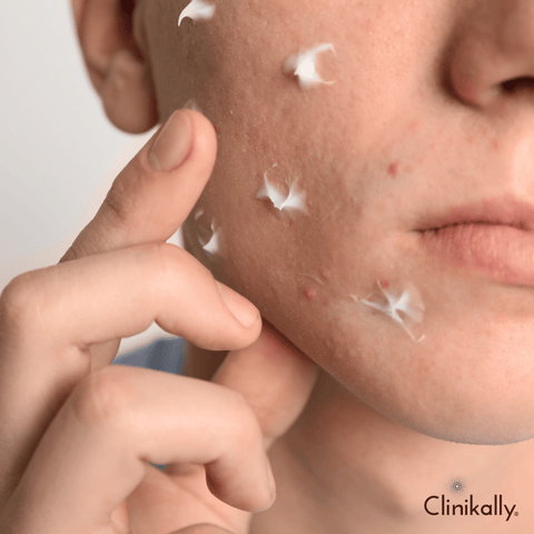 How To Get Rid of Dark Spots From Acne | ThriveCo