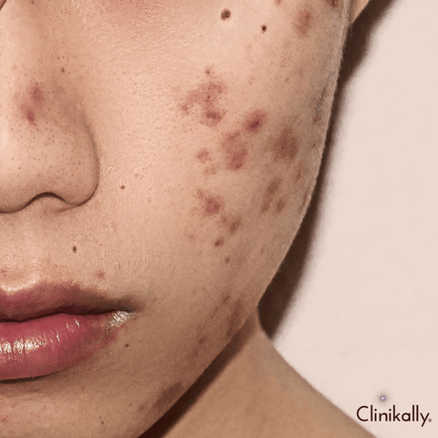 Understanding the Difference Between Acne Marks and Scars