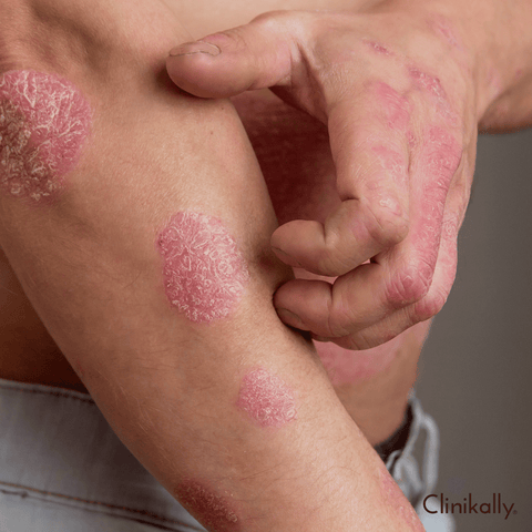 Eczema flare-ups causes