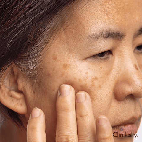 How to treat melasma